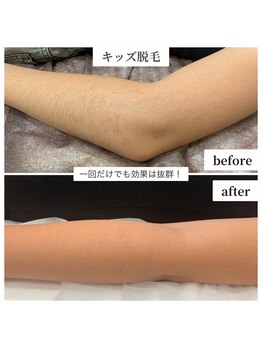 ポノ(Pono)/キッズ脱毛☆