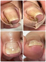 爪屋/巻き爪補正