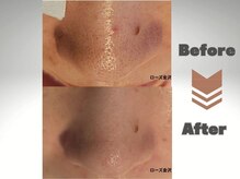 メディカルエステサロン ローズ 金沢本店(ROSE)/鼻　毛穴　ハイドラ変化