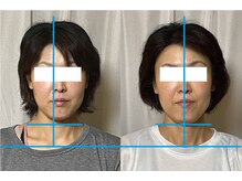 美容整体 アルマ/10回目：首の傾きは肩甲骨から