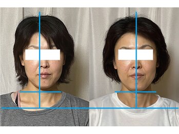 美容整体 アルマ/10回目：首の傾きは肩甲骨から