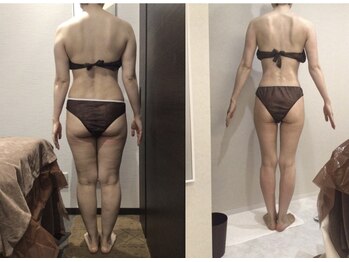 ボディベルム(BODY BELM)/ボコボコ、ゴリゴリセル脂肪