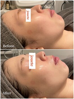 ジュエッテ(jouete)/第4世代ピーリング　ララピール