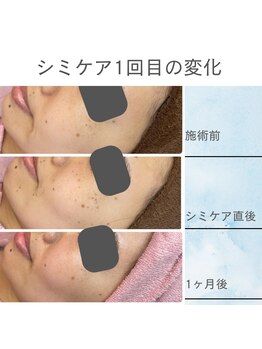 シフォン(Chiffon)/シミケア初回からの変化