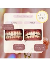 プラスビー 2号店(+b)/ホワイトニングビフォーアフター