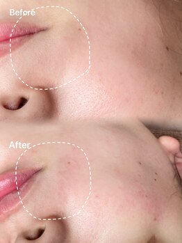 ミーククル(MEKUKURU)/フェイスワックス/顔脱毛