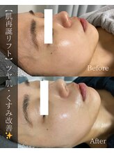 ブリリオプラス 四条烏丸店(Brillio plus)/肌再誕リフト3step