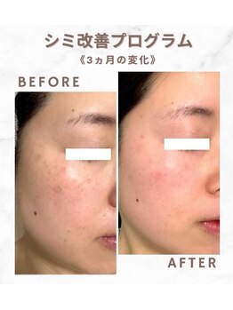 サロンソワ(salon Soi.)/ピュールボーテ：シミ改善