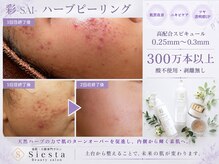 シエスタ(siesta)の雰囲気（ハーブピーリング/毛穴/毛穴洗浄/毛穴ケア/毛穴改善/ララピール）