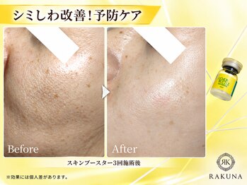 ラクナ(RAKUNA)の写真/韓国肌管理でシミ・しわ・くすみ・乾燥をケア！スキンブースターでぷる艶水光肌を目指しましょう♪