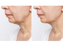 パーフェクトフェイスビューティー 梅田店(PERFECT FACE BEAUTY)/たるみ改善/リフトアップ