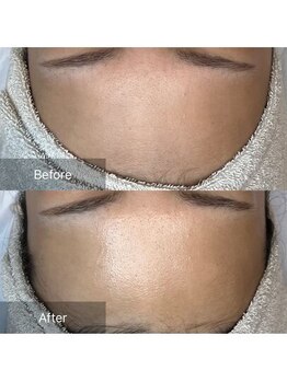 ホワイトアクア つくば店(WHITE AQUA)/ララピール/ つくば/茨城/艶肌