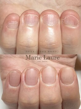 マリーロール 天王寺店(Marie Laure)/深爪矯正/自爪育成/ネイルケア/
