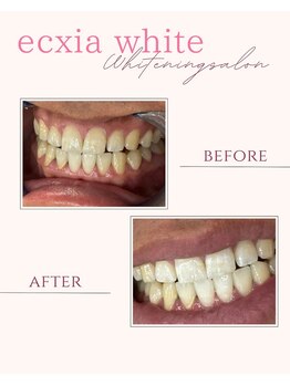 エクシアホワイトニング 倉敷店/ホワイトニングビフォーアフター