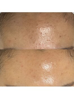 リシェリ 代官山(RICHERI)/頑固な額ニキビにも!セラピール