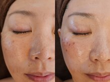 フリージア(Freesia)/　シミケア＋ヒト幹フェイシャル