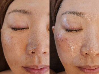 フリージア(Freesia)/　シミケア＋ヒト幹フェイシャル