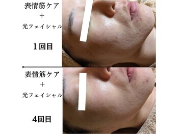 ラーナ(Lana)/光フェイシャル＋表情筋ケア