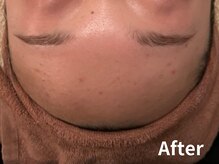 ダイヤモンド リーエンダ(Diamond leende)/クレイハーブピーリング