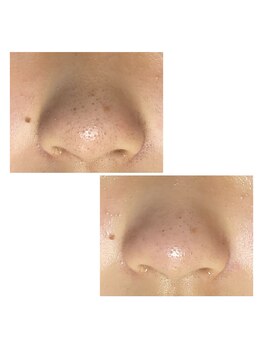 ヴァロ(Valo)/オプションメニュー 毛穴洗浄