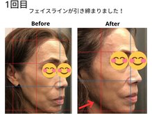 ベル/50代の方の小顔Before After