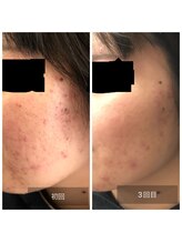 ミドリ(MIDORI)/繰り返すニキビ徹底ケア症例7