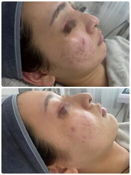 ファーファラ(Farfalla)/ハーブピーリング