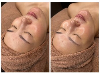 ホワイトアクア 梅田本店(WHITE AQUA)/ララピール/大阪/梅田/毛穴