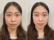 福多整体院/小顔美肌1回の効果