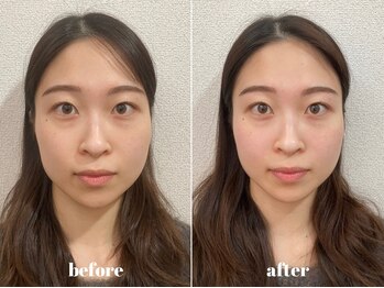 福多整体院/小顔美肌1回の効果