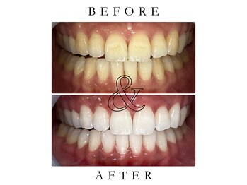 ジュエルホワイトニング/ホワイトニングビフォーアフター