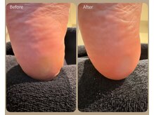 セレネス(SERENESSE)/Before and after