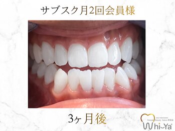 ホワイヤ セルフホワイトニング DBS神楽坂(Whi-Ya)/☆サブスク会員様☆納得の白さ☆