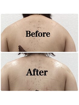 ルピア(L'pur)/肩のサイズダウン