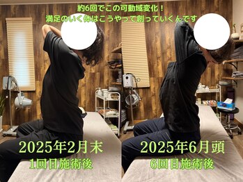 アポヨ鍼灸院(APOYO鍼灸院)/整体6回 before/after 期間5ヶ月