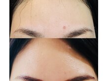 リム ビューティー(RYM BEAUTY)/ニキビケア、肌荒れにも