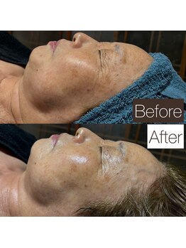 東京デトックス/60代後半女性。レチノールF90分