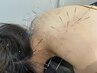 【2～4部位の鍼施術】ルート鍼45分コース　初回10,000円→7,500円