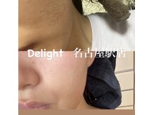ディライト 名古屋駅店(Delight)/ニキビケアにはハードタイプ！