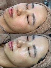 ホワイトアクア つくば店(WHITE AQUA)/ララピール/ つくば/茨城/小顔