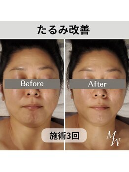 ミピマム 横浜駅前店/たるみ改善 お客様Before After