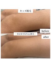 ポノ(Pono)/キッズ脱毛☆