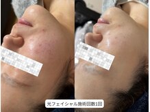 サロン アンネ(Anne)/光フェイシャル