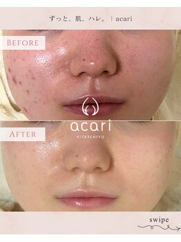 アカリ(acari)の写真/【気になる毛穴の開き/黒ずみ】普段取り除けない汚れを電気の力で取り除く エレクトロブラシでノーファンデ