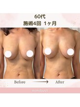 ミミバスト(mimibust)/バストアップBeforeAfter