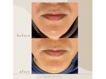 リモアボーテ(RIMOA beaute)/施術メニュー　お顔まるごと脱毛