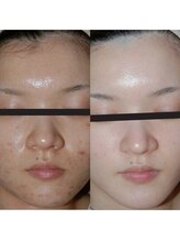 ホワイトアクア つくば店(WHITE AQUA)/ララピール/ つくば/茨城/艶肌