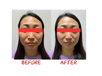 フラット柏(FLAT柏)/美容鍼before&after 【小顔】
