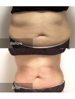 プリマルーチェ/プレミアムお腹プログラム