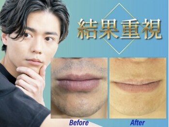 オーシャンブルー 佐世保店(OCEAN BLUE)/結果重視の髭脱毛